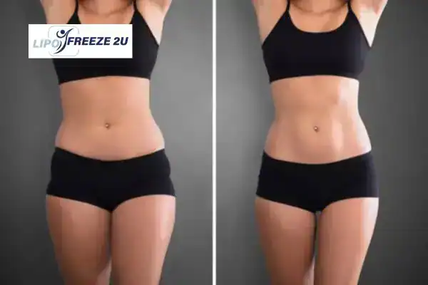 How Can LIPO FREEZE 2U Support Your Post-Pregnancy Body Recovery Peterborough?