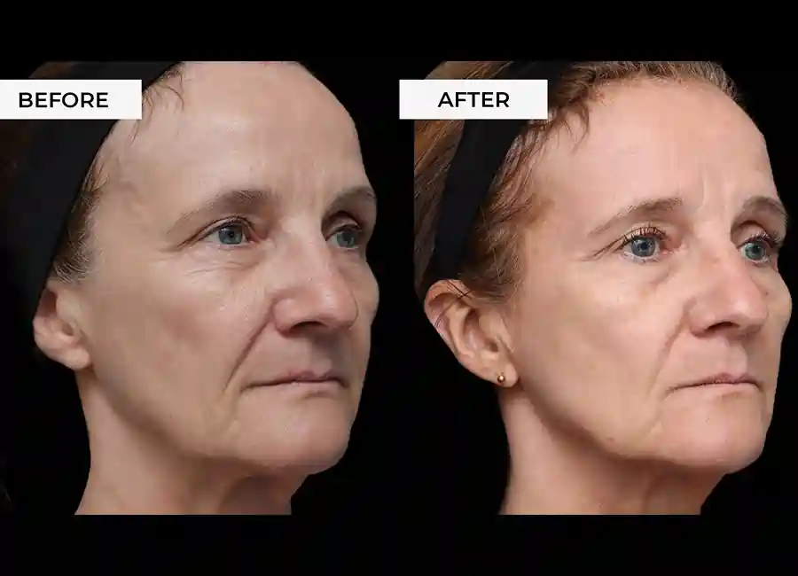How Many RF Microneedling Sessions Will You Need to See a Difference Peterborough?