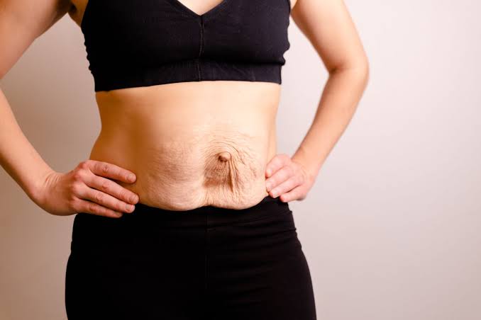 Is Surgery Really the Only Way to Repair Diastasis Recti Peterborough?