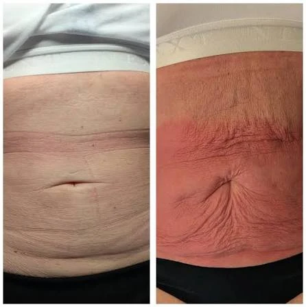 How Does RF Microneedling Improve Crepey, Thin and Uneven Skin Texture Peterborough?