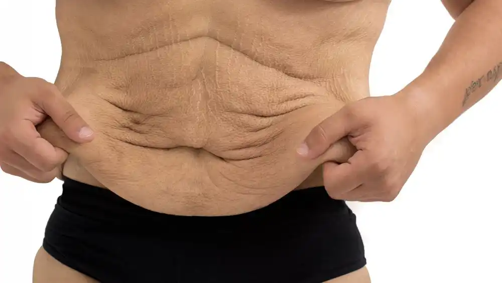 Why Does Weight Loss Medication Leave Some People With Loose or Sagging Skin Peterborough?